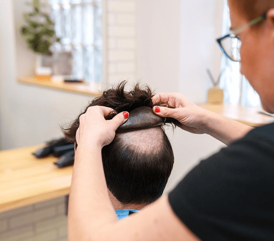 Non-Surgical Hair Patch System
